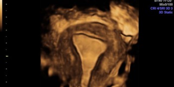 Real time three dimensional ultrasound scans can almost replace diagnostic hysteroscopy