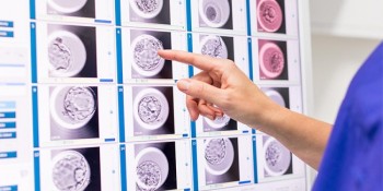 Time lapse imaging (embryoscope) in IVF